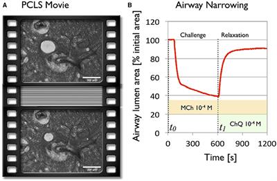 Airway and Parenchymal Strains during Bronchoconstriction in the Precision Cut Lung Slice